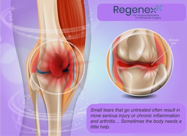 Bone Marrow Stem Cell Therapy