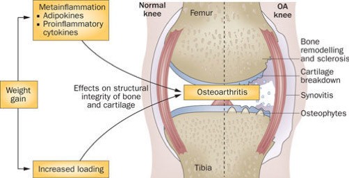 Arthritis, Southlake | Rheumatoid Arthritis, Osteoarthritis Treatment ...